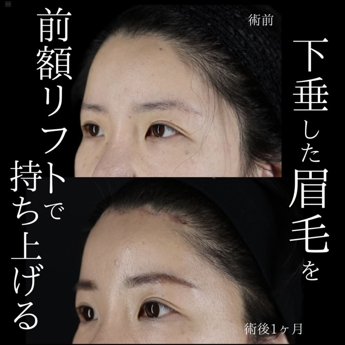 フェイスリフト