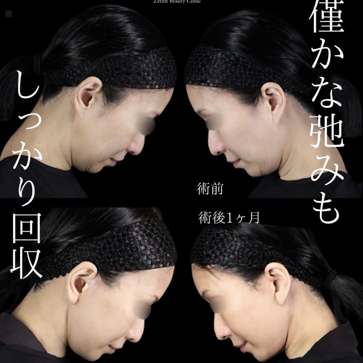 副島医師によるフェイスリフトの術前/術後8日目 施術後 