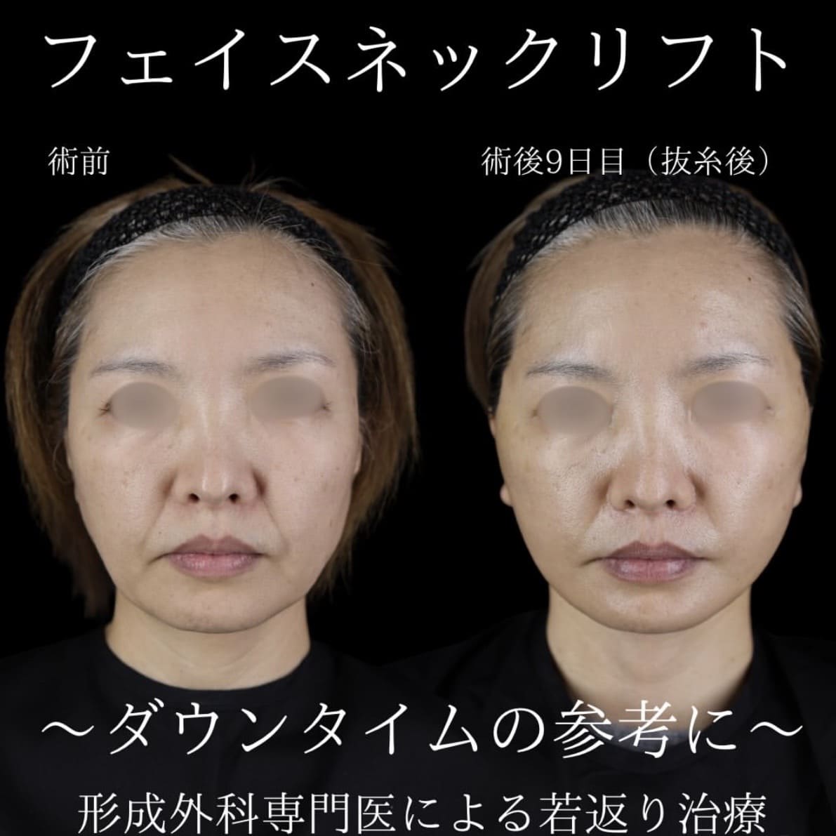 副島医師によるフェイスリフトの術前/術後9日目 施術後 