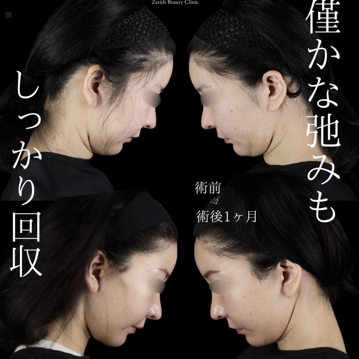 フェイスリフト