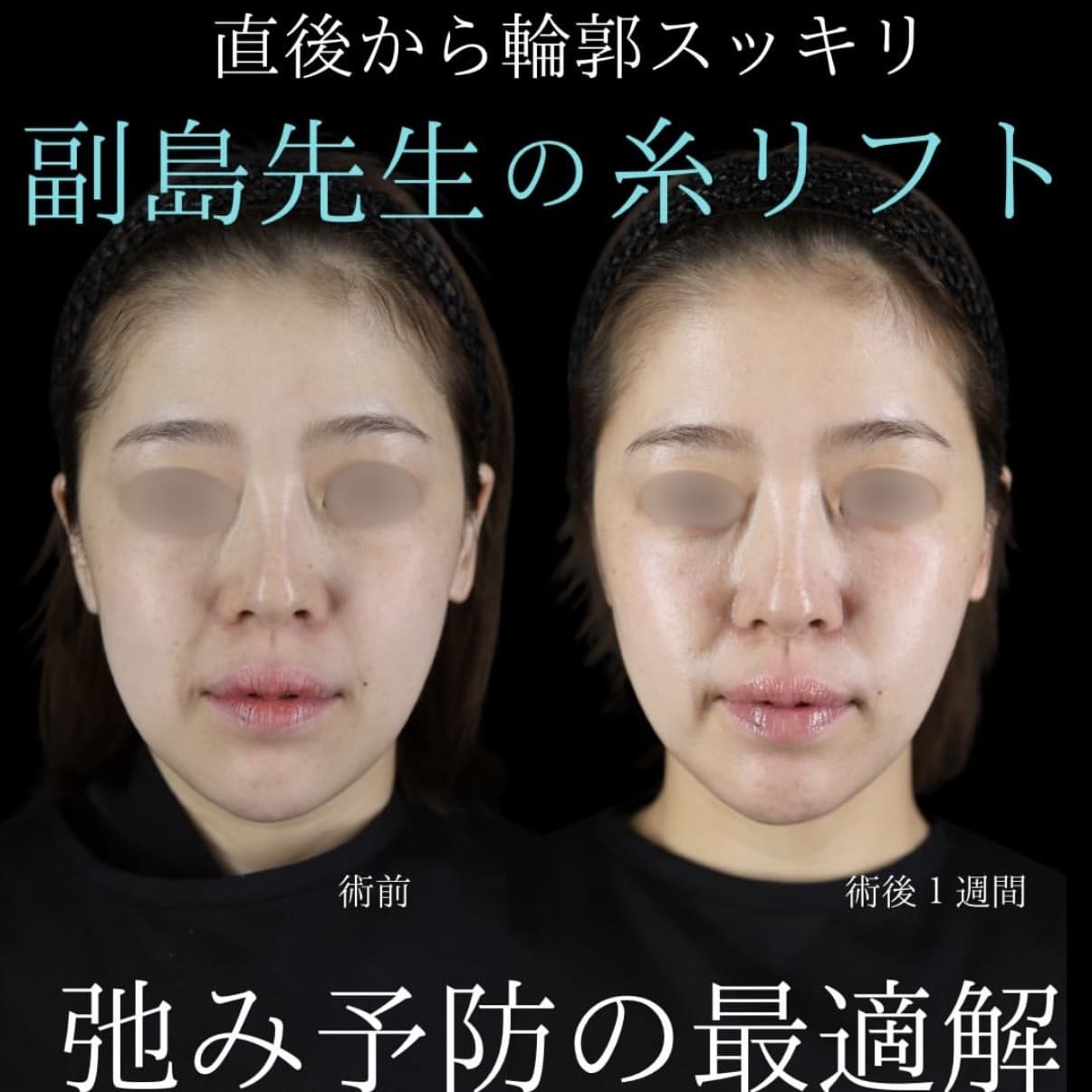たるみ治療