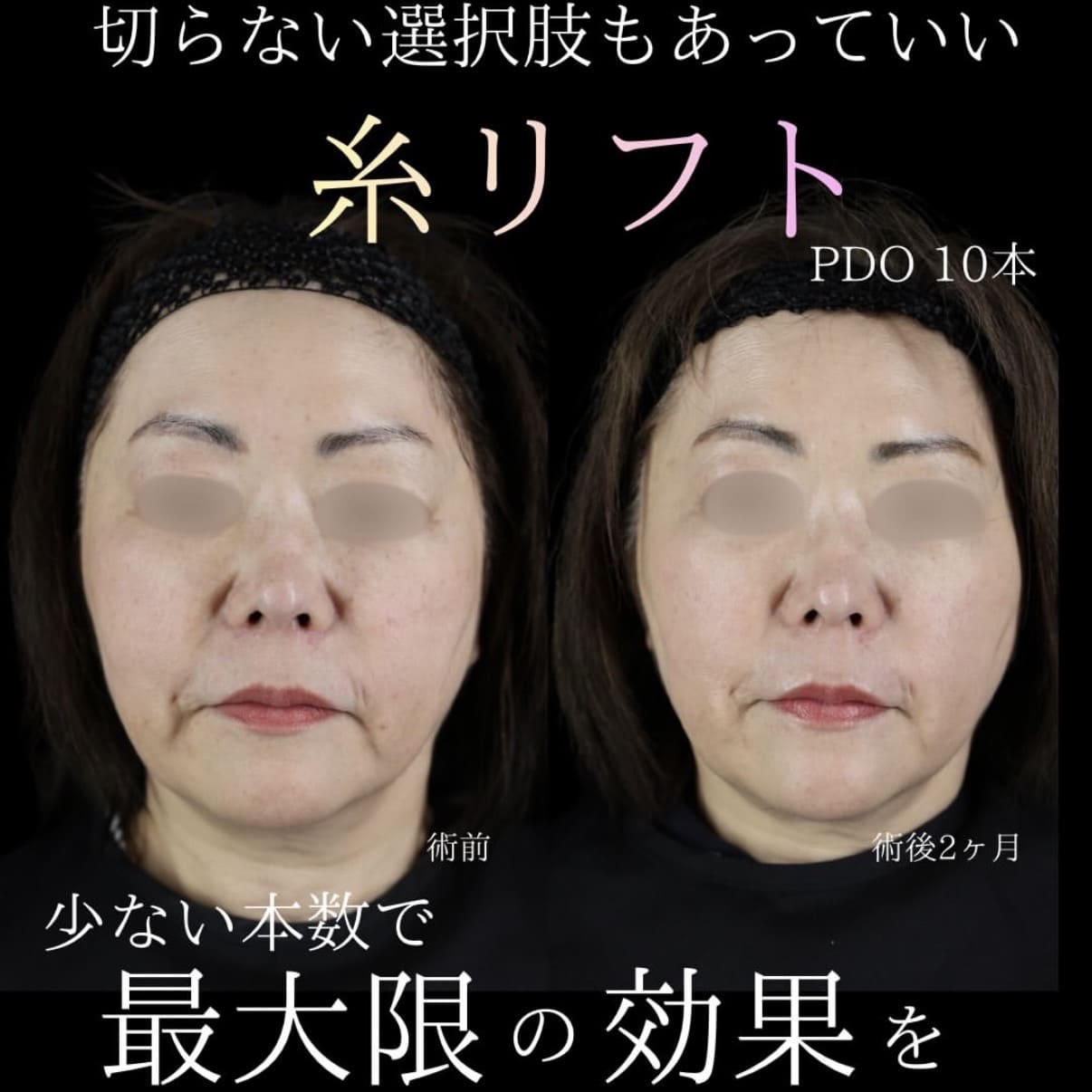 たるみ治療