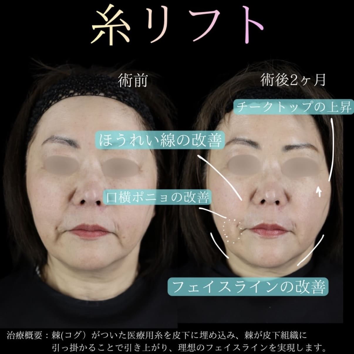 副島医師による糸リフトの術前/術後2ヶ月 施術後 