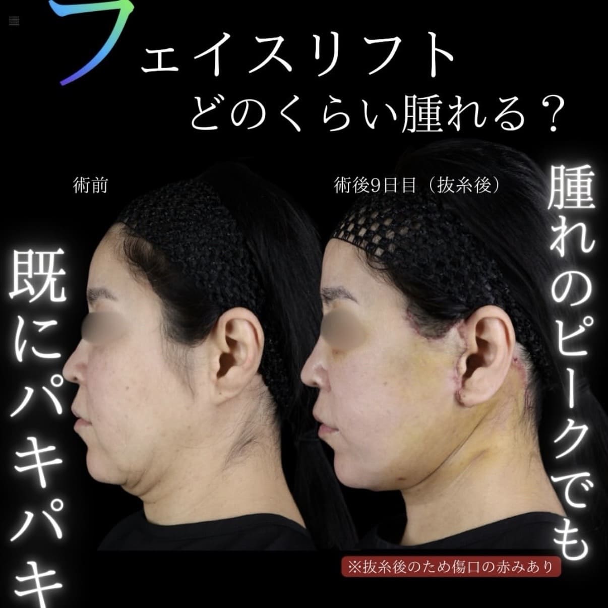 フェイスリフト