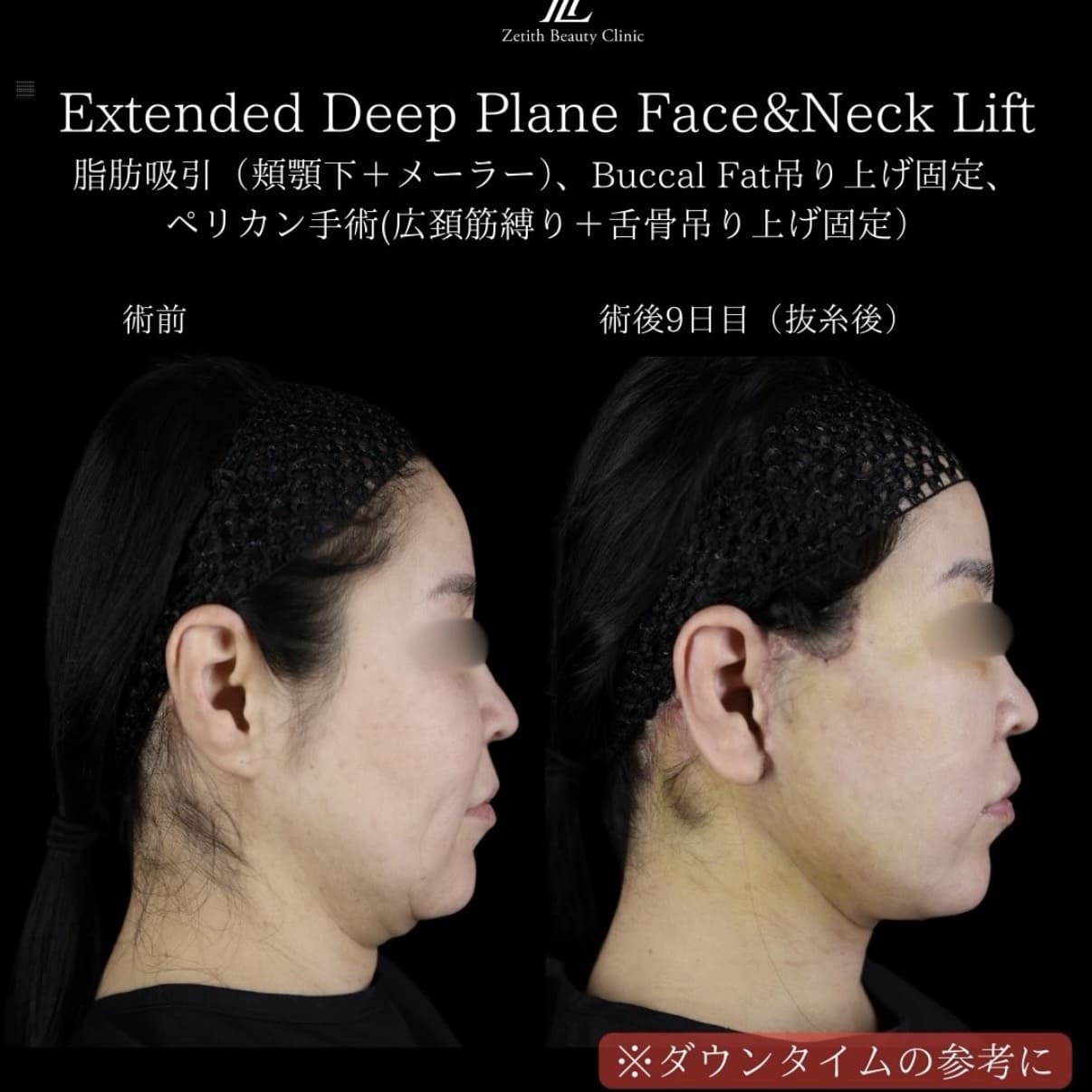 副島医師によるフェイスリフトの術前/術後9日 施術後 