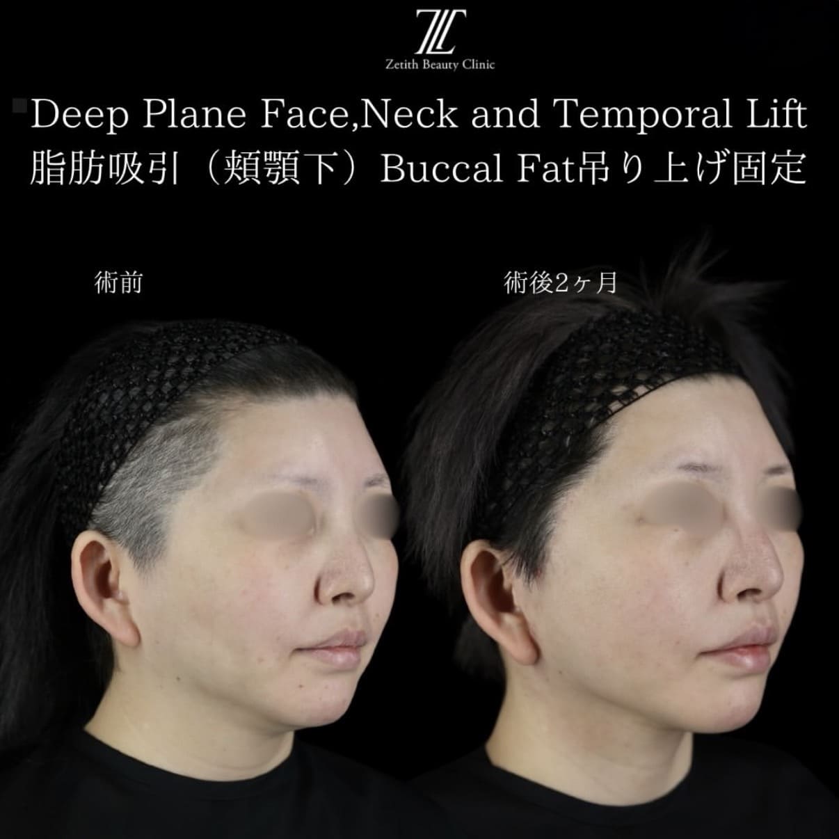 副島医師によるフェイスリフトの術前/術後2ヶ月 Sau 