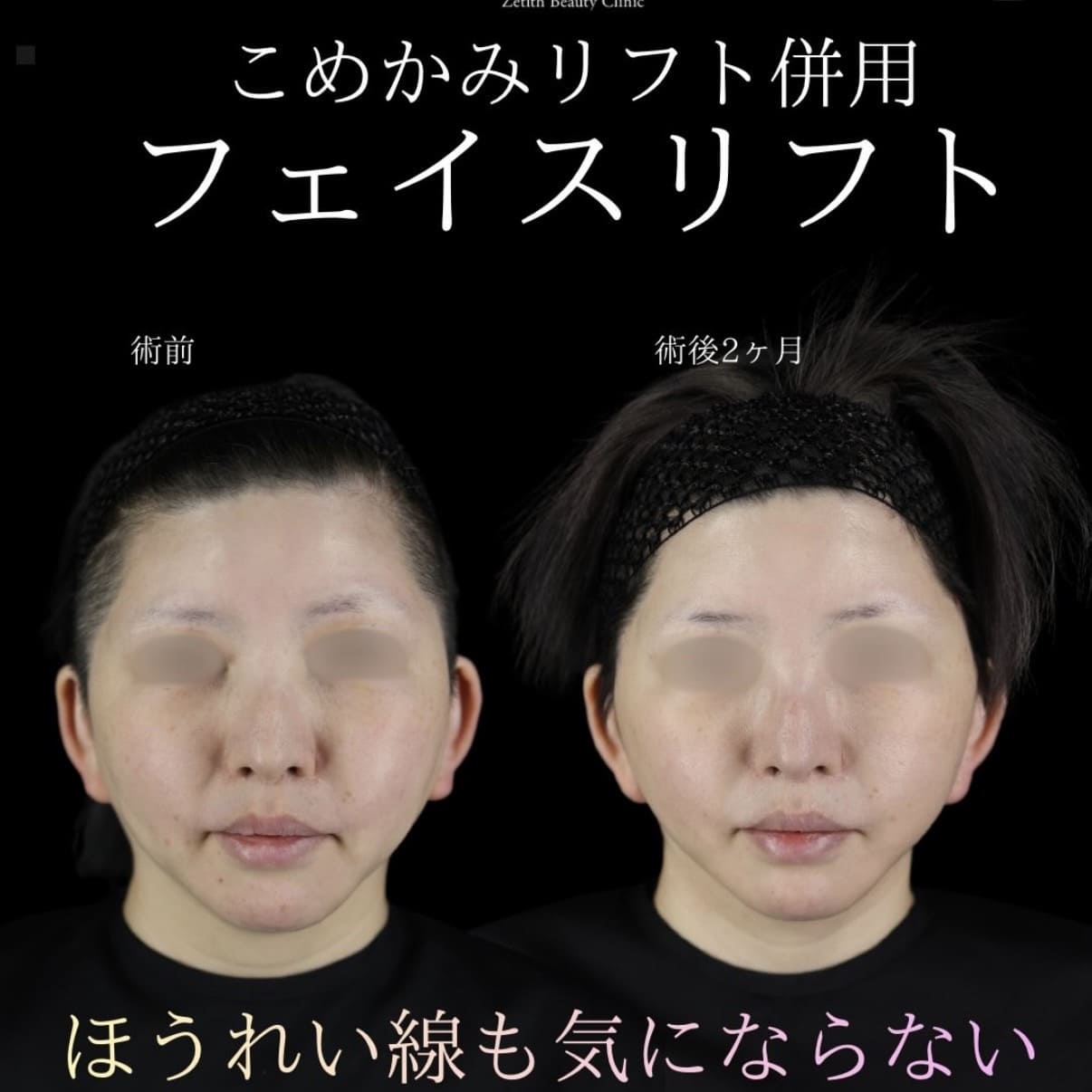 フェイスリフト