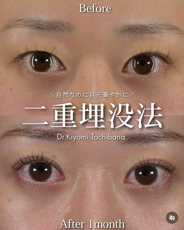 二重埋没法