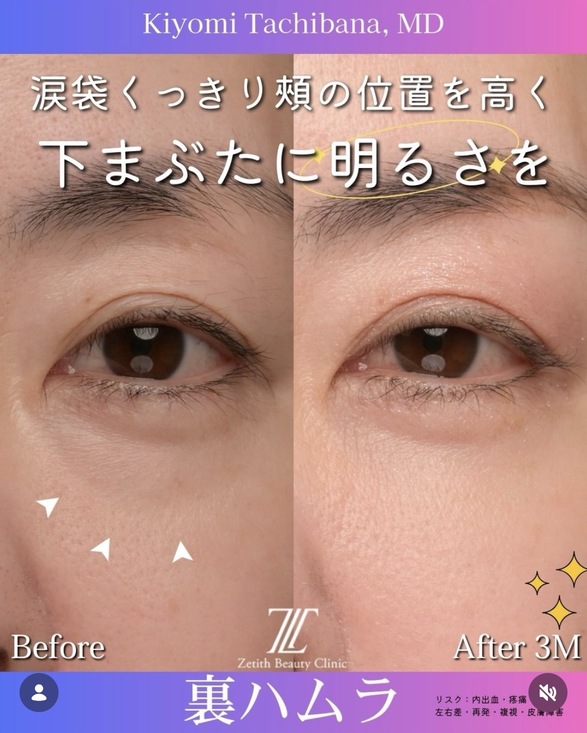 裏ハムラ