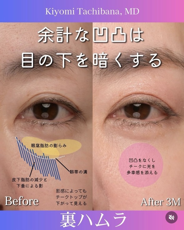 橘医師による裏ハムラの術前/術後3ヶ月 หลัง 
