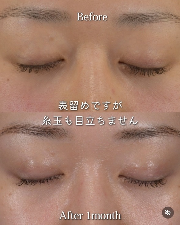 橘医師による二重埋没法の術前/術後1ヶ月 After 