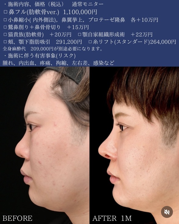 守屋医師による複合手術の術前/術後1ヶ月 施術後 