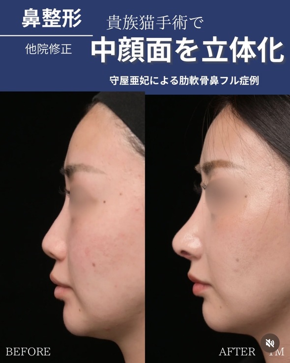 鼻整形