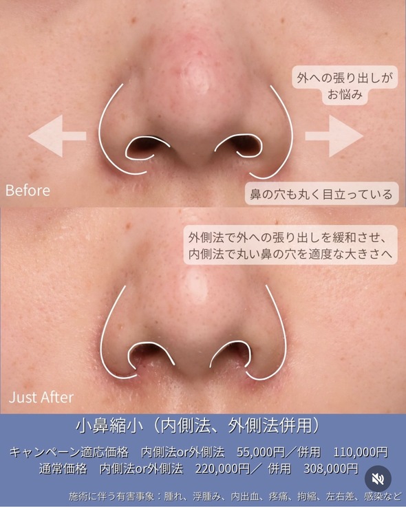 守屋医師による鼻整形の術前/術後1ヶ月 หลัง 