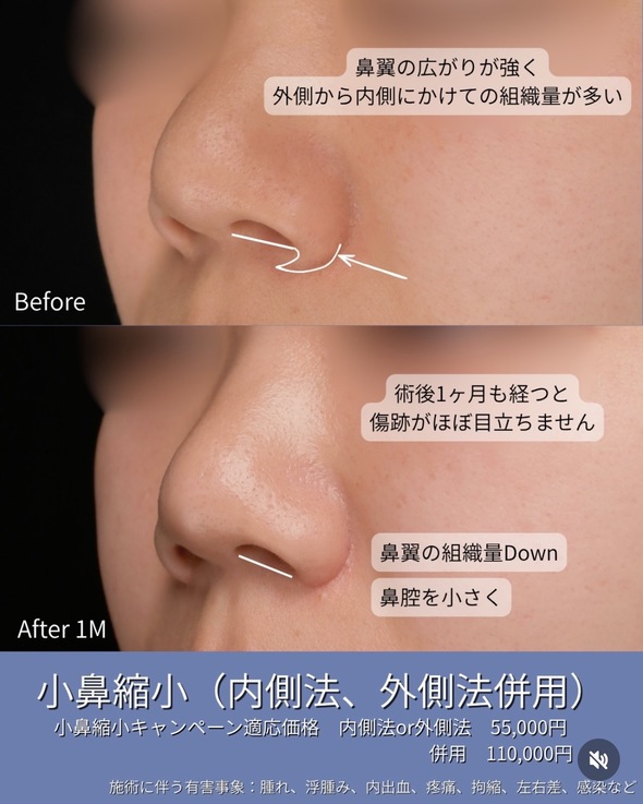 守屋医師による鼻整形の術前/直後 施術後 