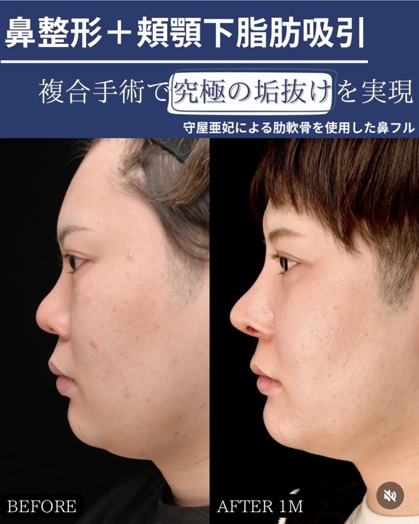 Nose | By Concern — Zetith Beauty Clinic