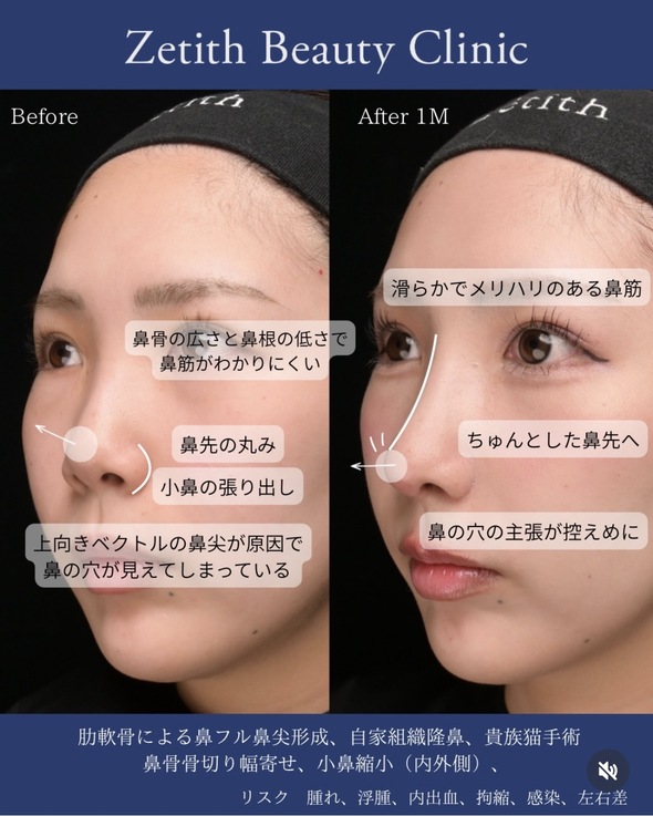守屋医師による鼻整形の術前/術後1ヶ月 术后 