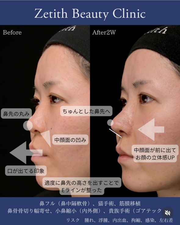 守屋医師による鼻整形の術前/術後2週間 Дараа 