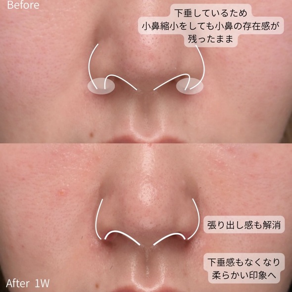 守屋医師による鼻整形の術前/術後3ヶ月 After 