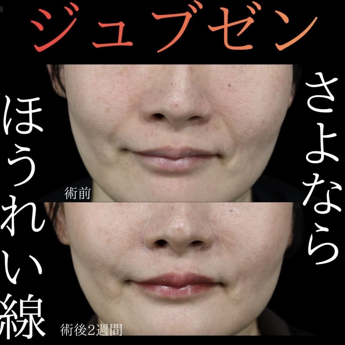 シワ治療