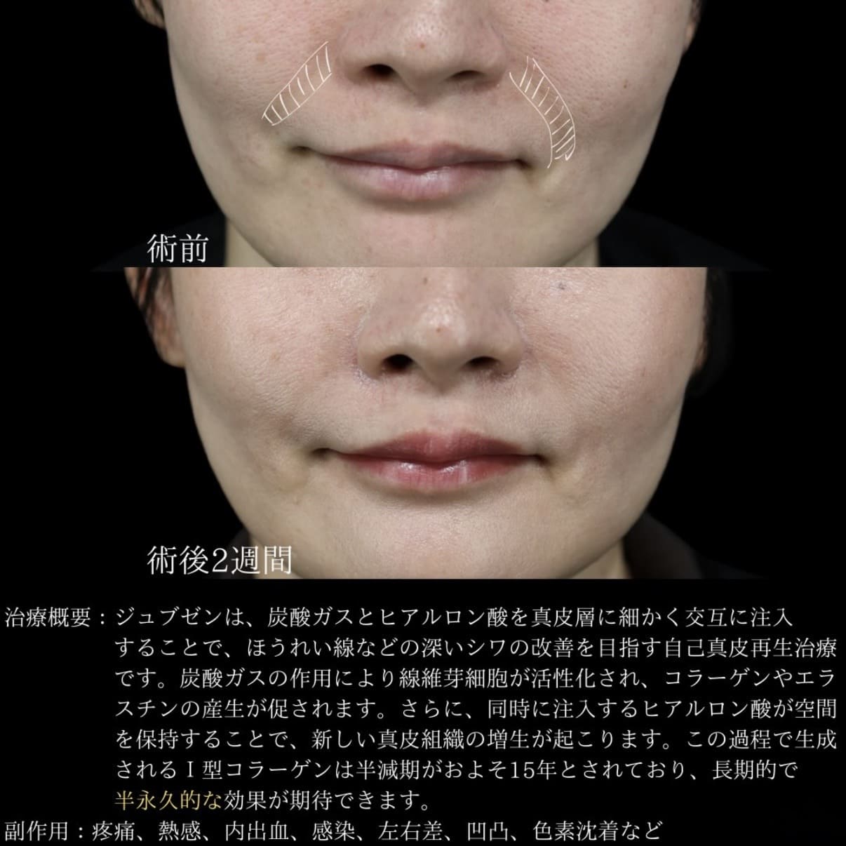 副島医師によるJUVGENの術前/術後2週間 Дараа 