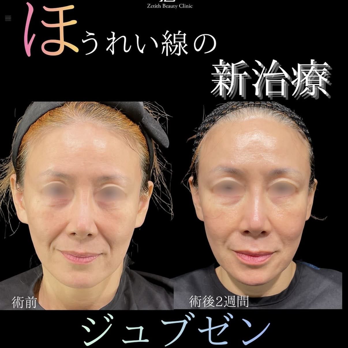 シワ治療