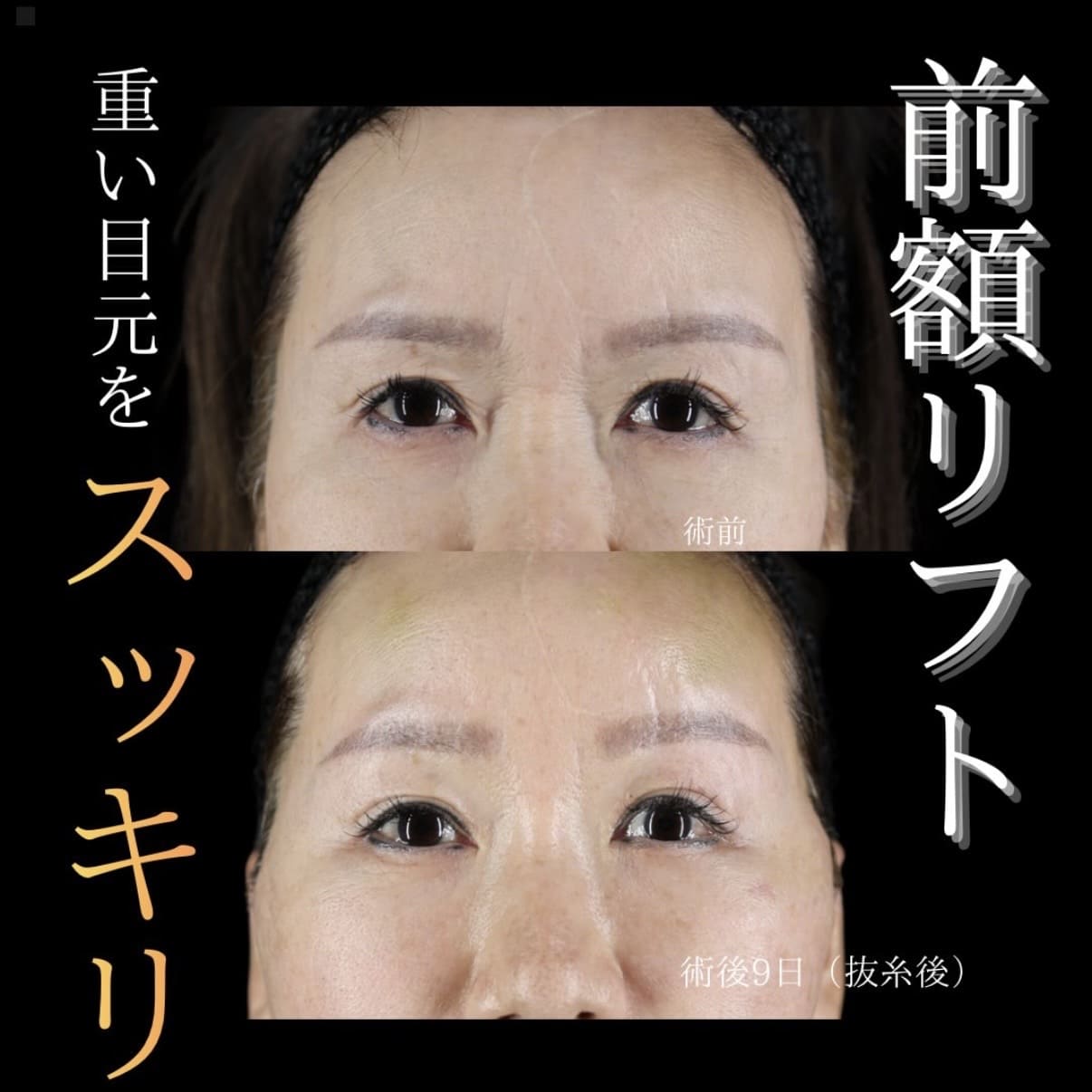 フェイスリフト