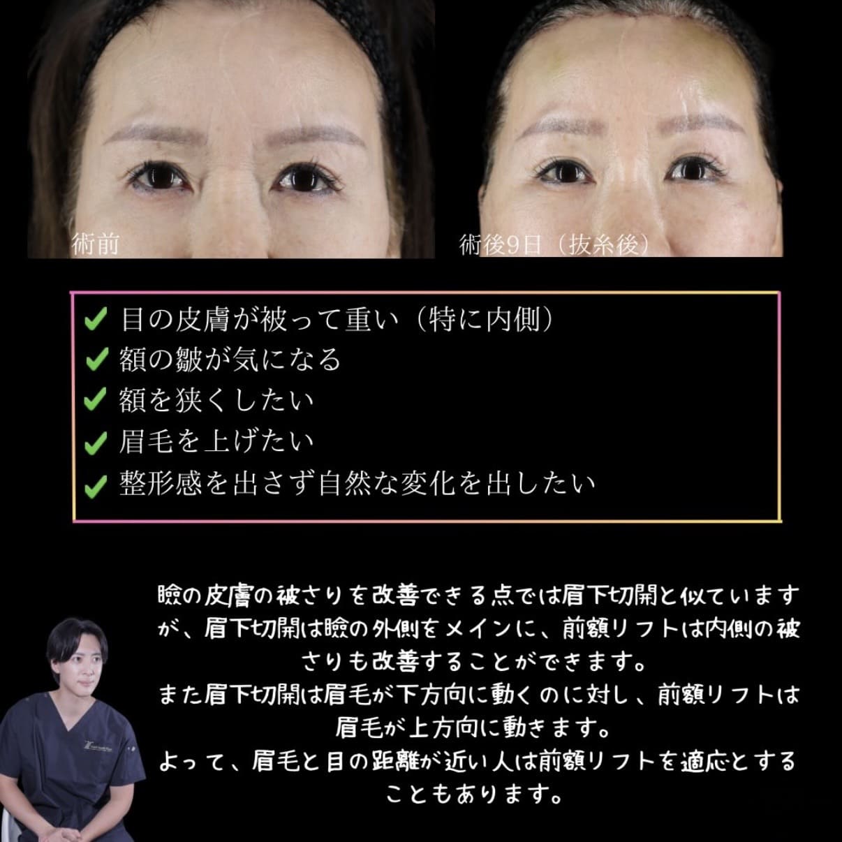 副島医師による前額リフトの術前/術後9日 بعد 