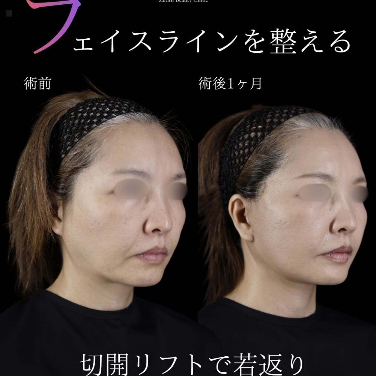 フェイスリフト
