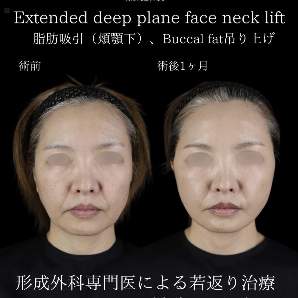 副島医師によるフェイスリフトの術前/術後1ヶ月 بعد 