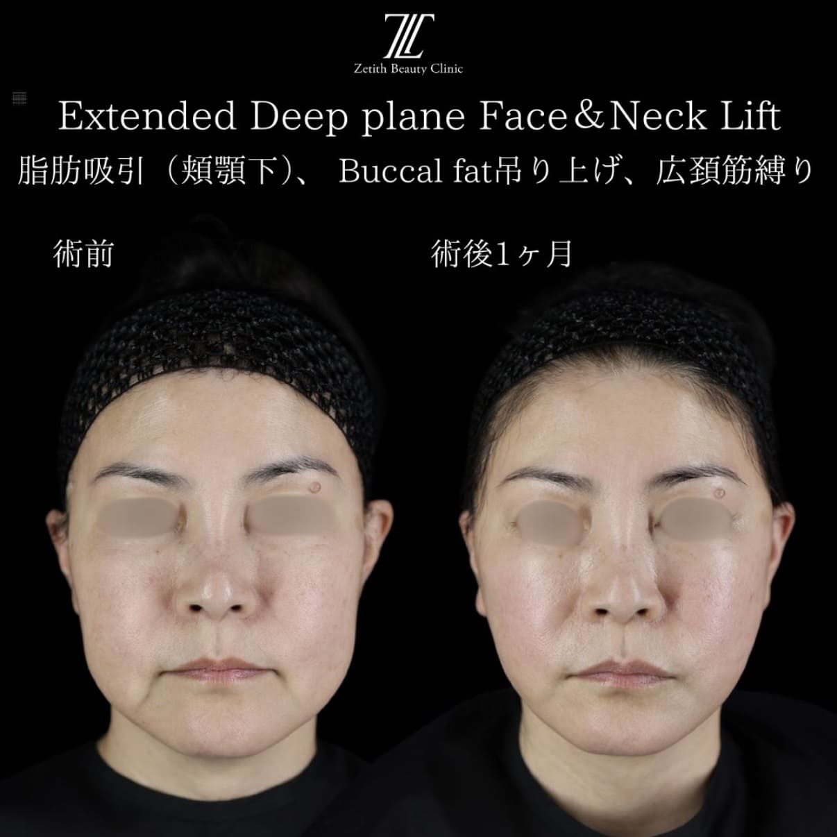 フェイスリフト