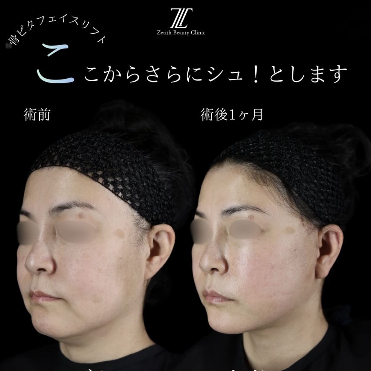 副島医師によるフェイスリフトの術前/術後1ヶ月 After 