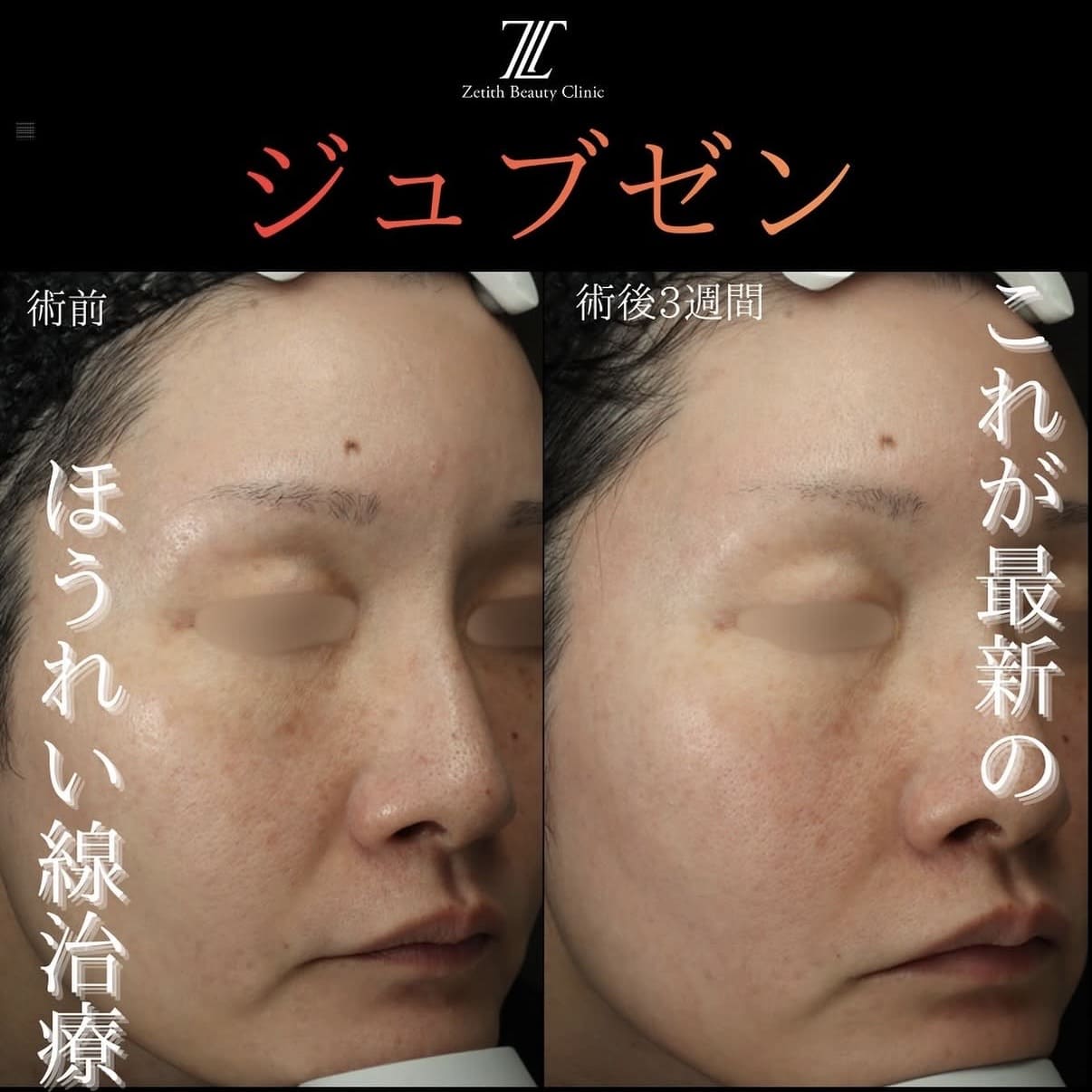 シワ治療