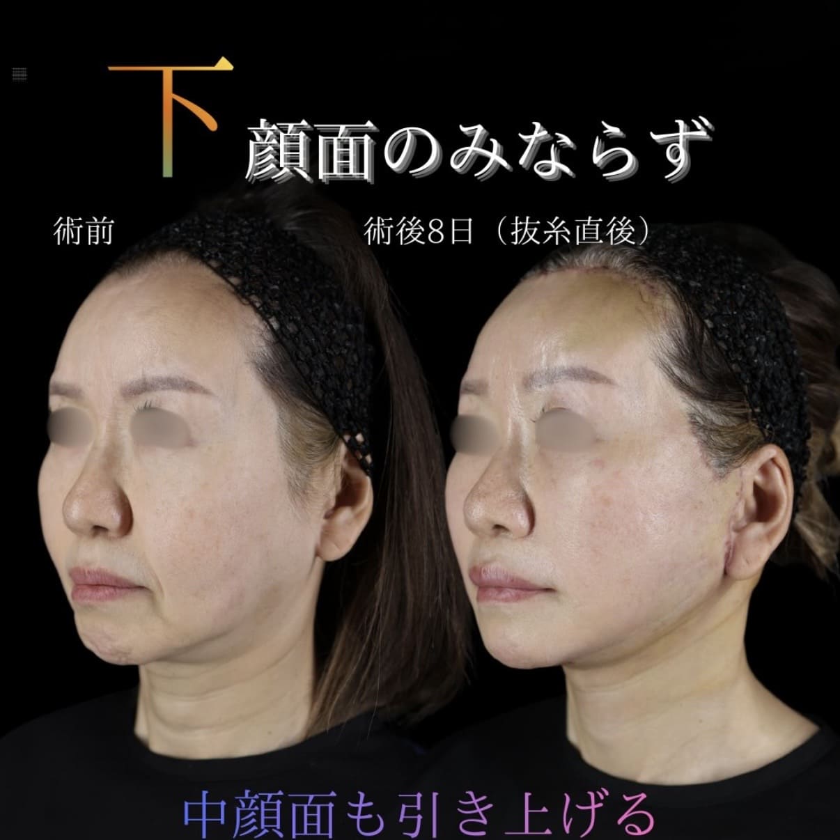 フェイスリフト