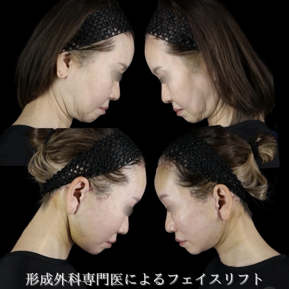 副島医師によるフェイスリフトの術前/術後8日 施術後 