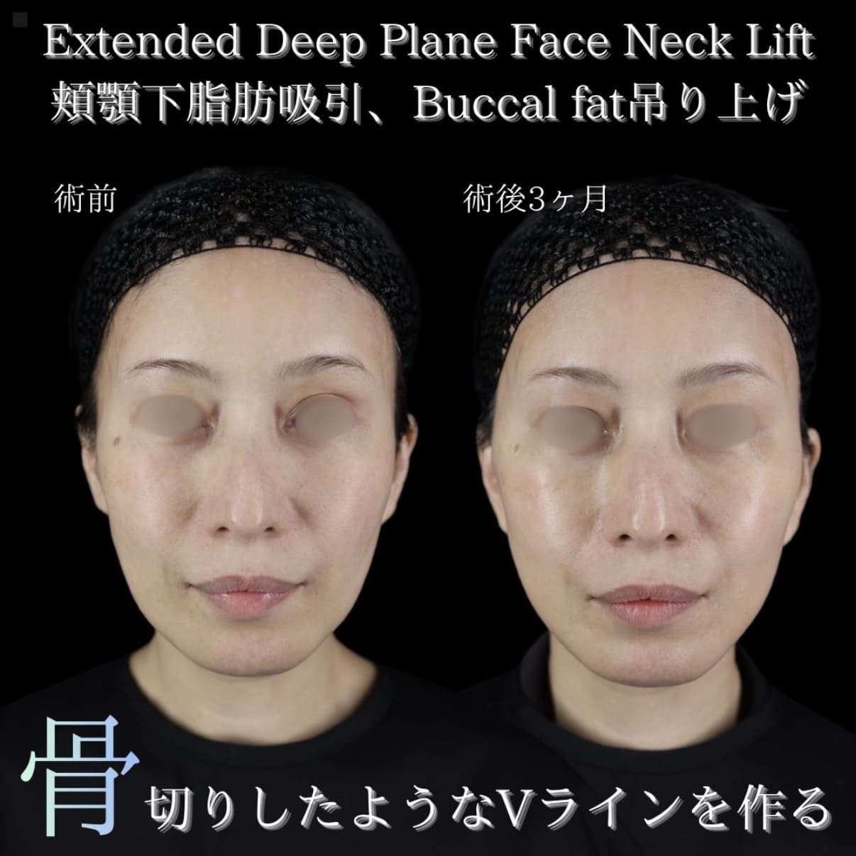 フェイスリフト