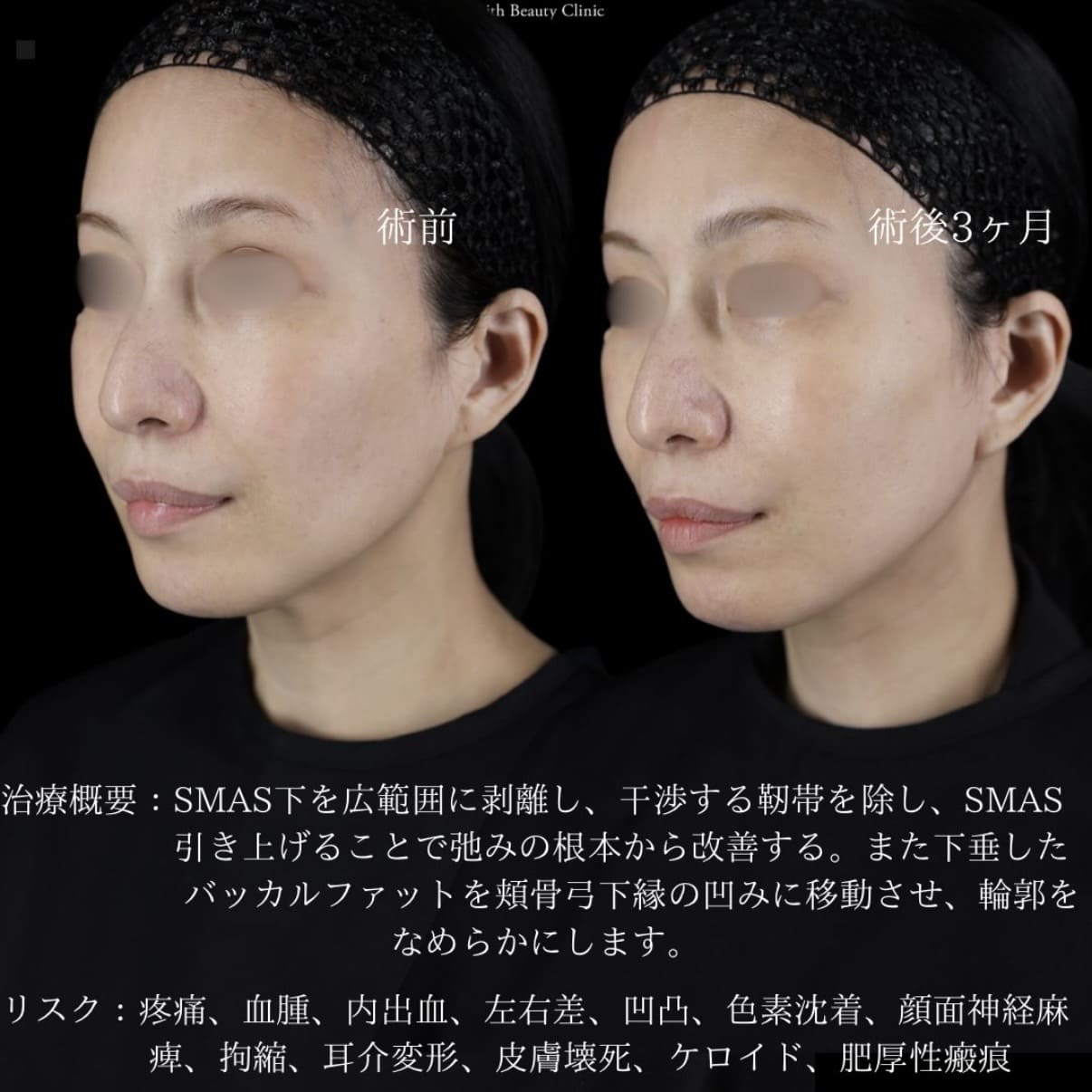 副島医師によるフェイスリフトの術前/術後3ヶ月 施術後 