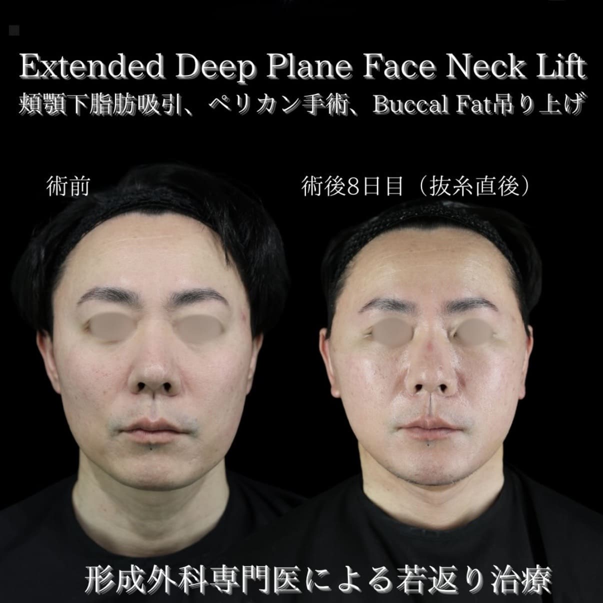 副島医師によるフェイスリフトの術前/術後8日 施術後 