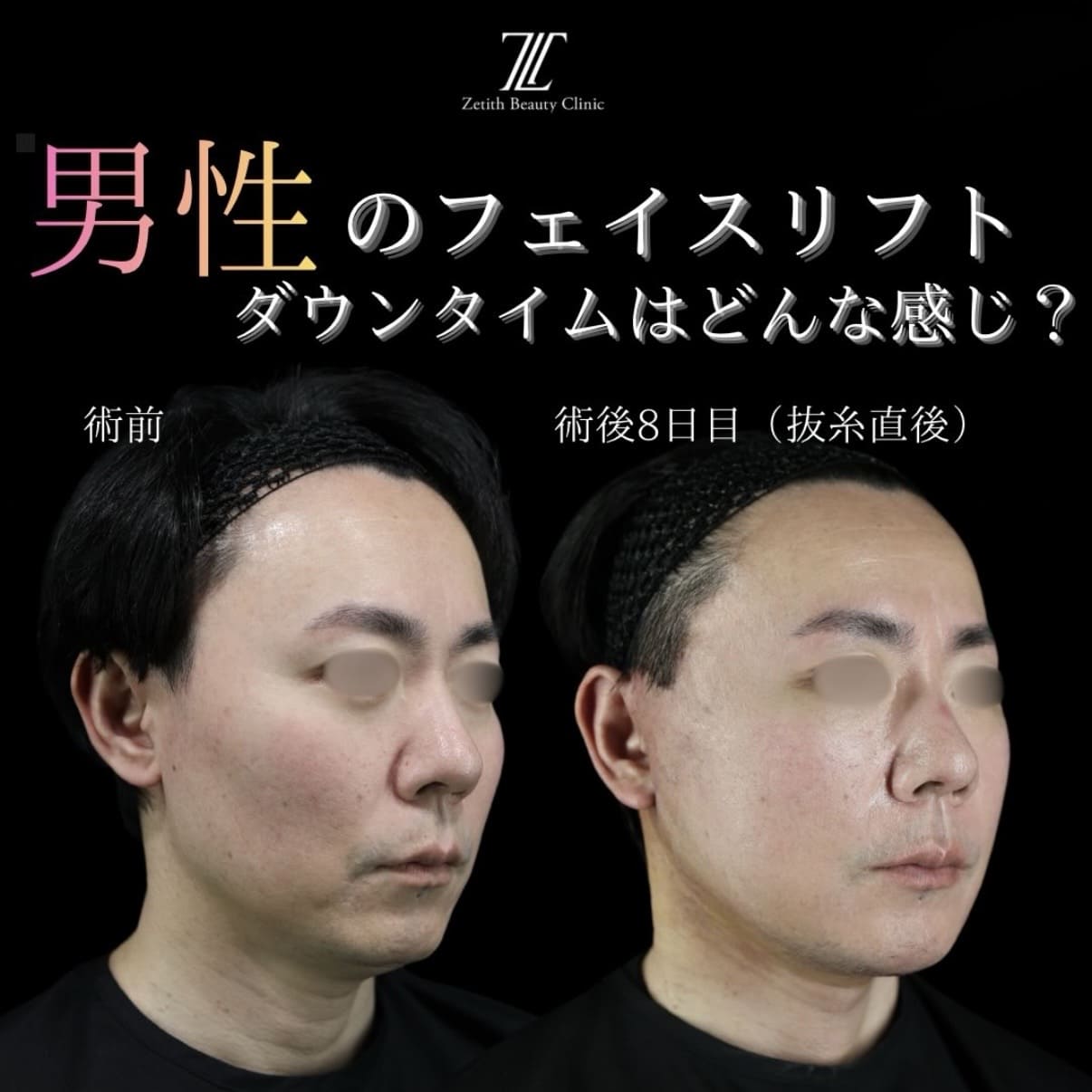 フェイスリフト