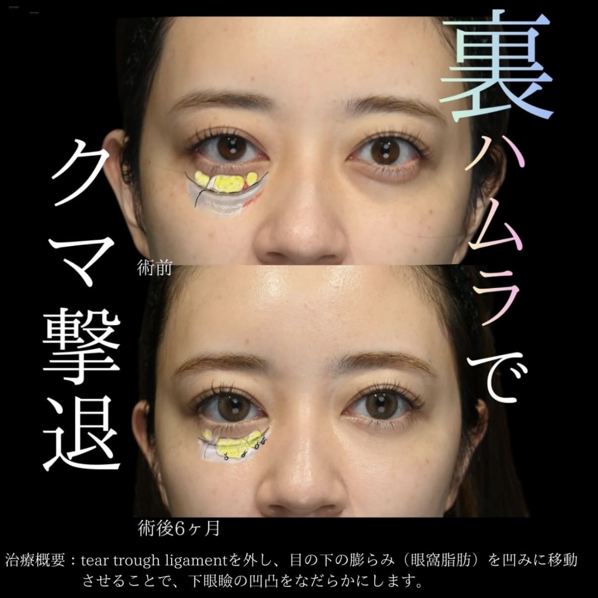 副島医師によるクマ取りの術前/術後6ヶ月 بعد 