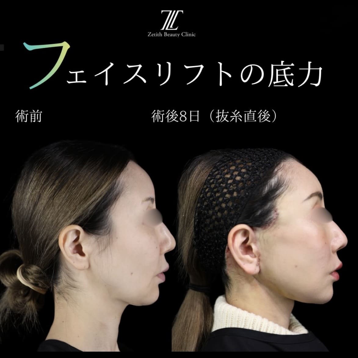 フェイスリフト