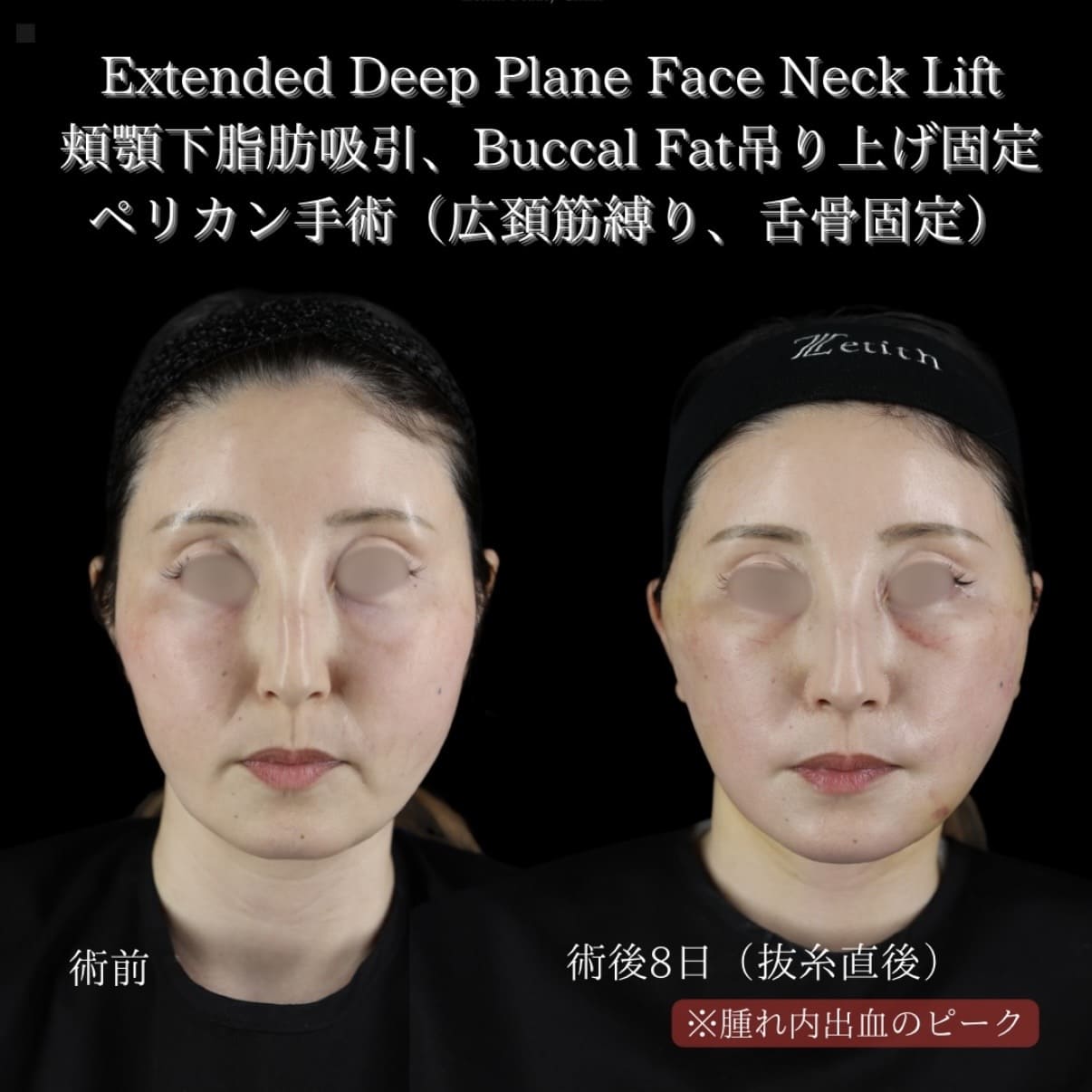 フェイスリフト