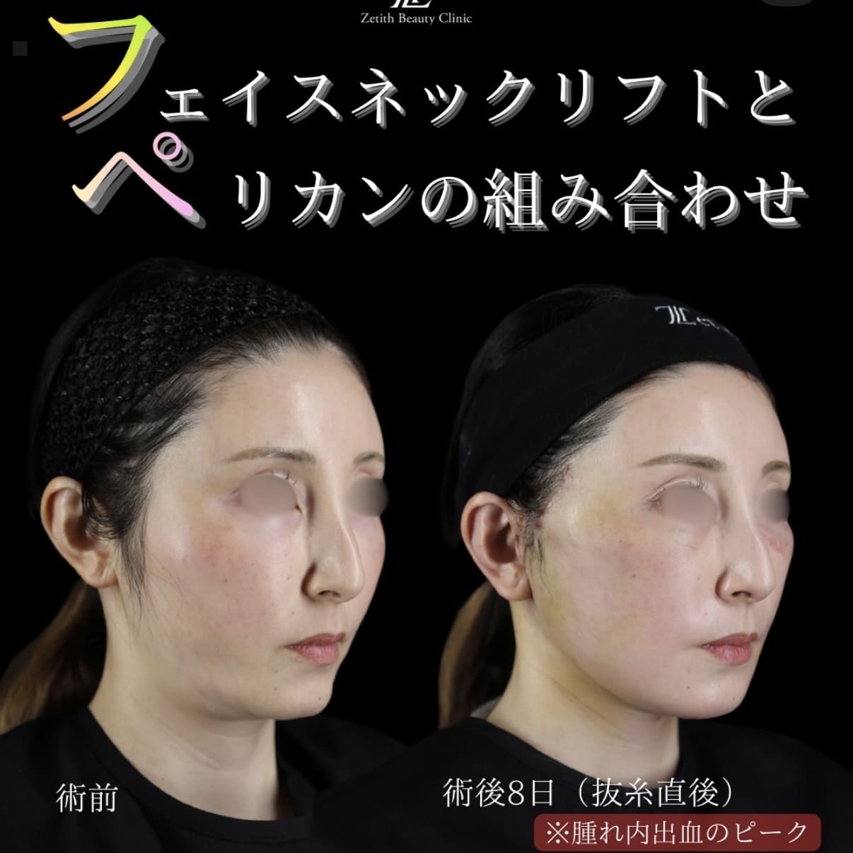 副島医師によるフェイスリフトの術前/術後8日 施術後 