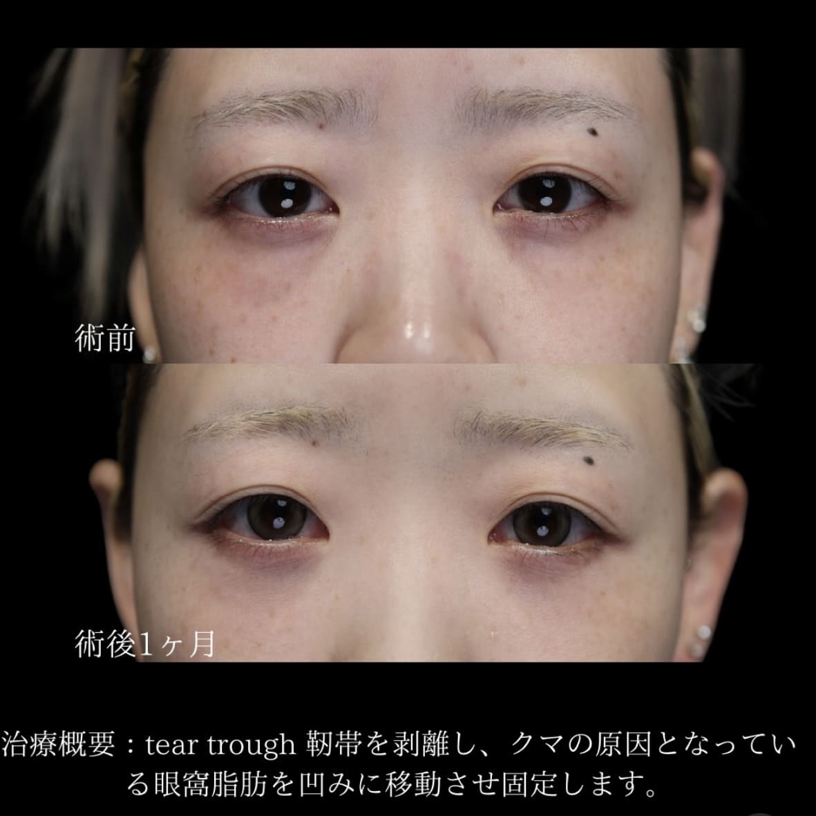 副島医師によるクマ取りの術前/術後1ヶ月 Дараа 