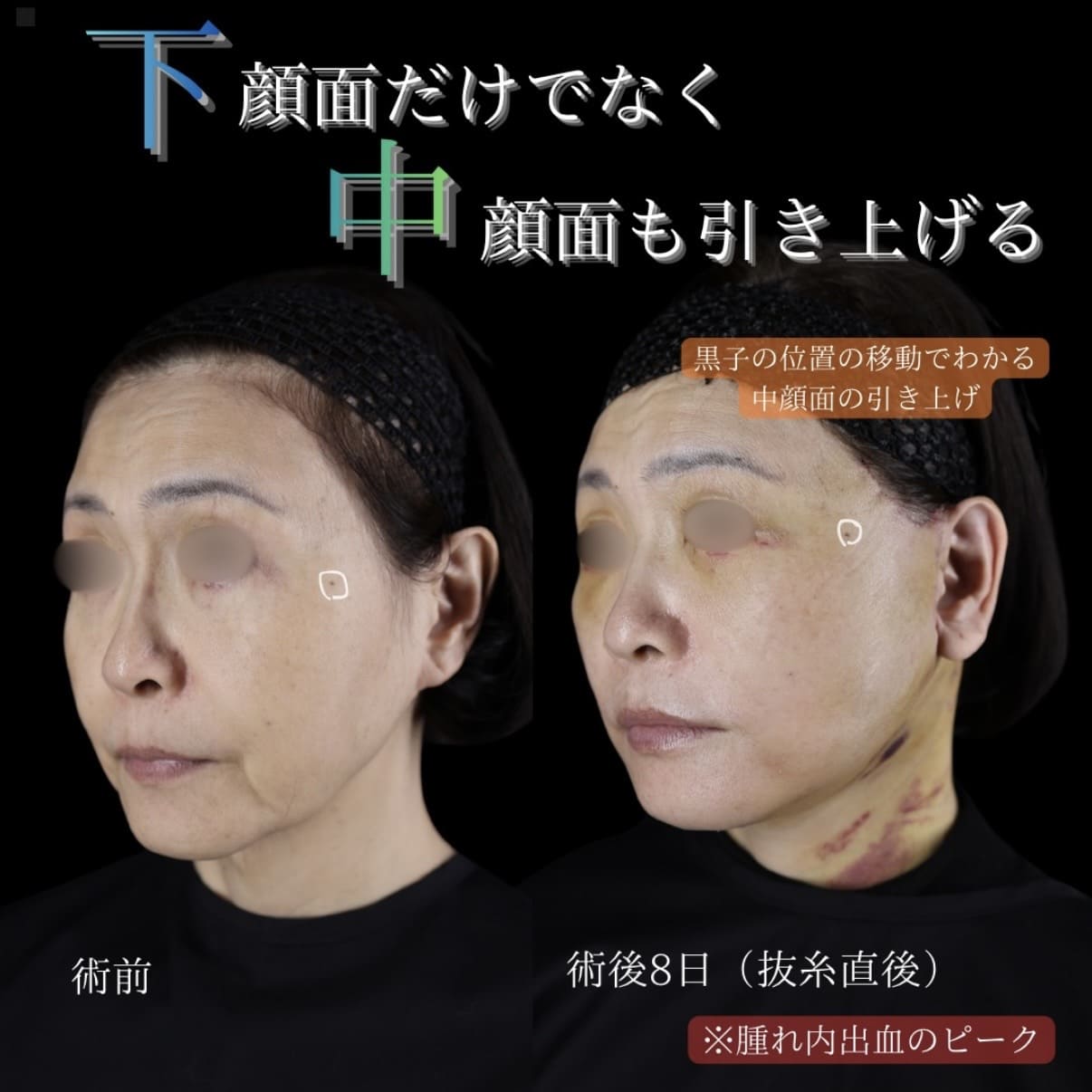 副島医師によるフェイスリフトの術前/術後8日 施術後 