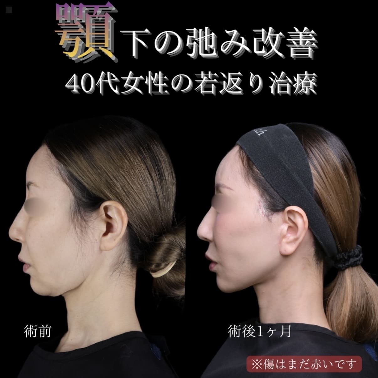 フェイスリフト
