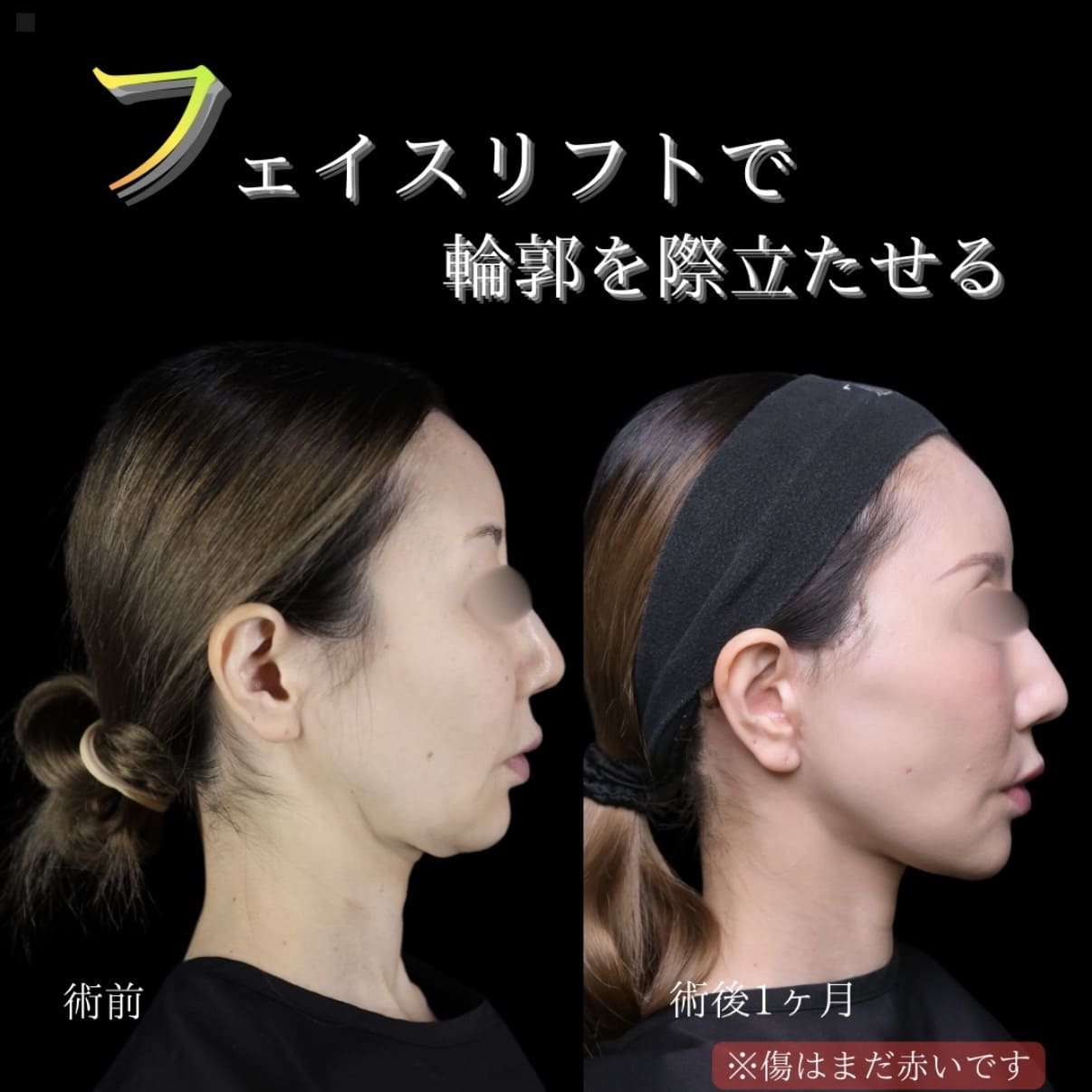 副島医師によるフェイスリフトの術前/術後1ヶ月 施術後 