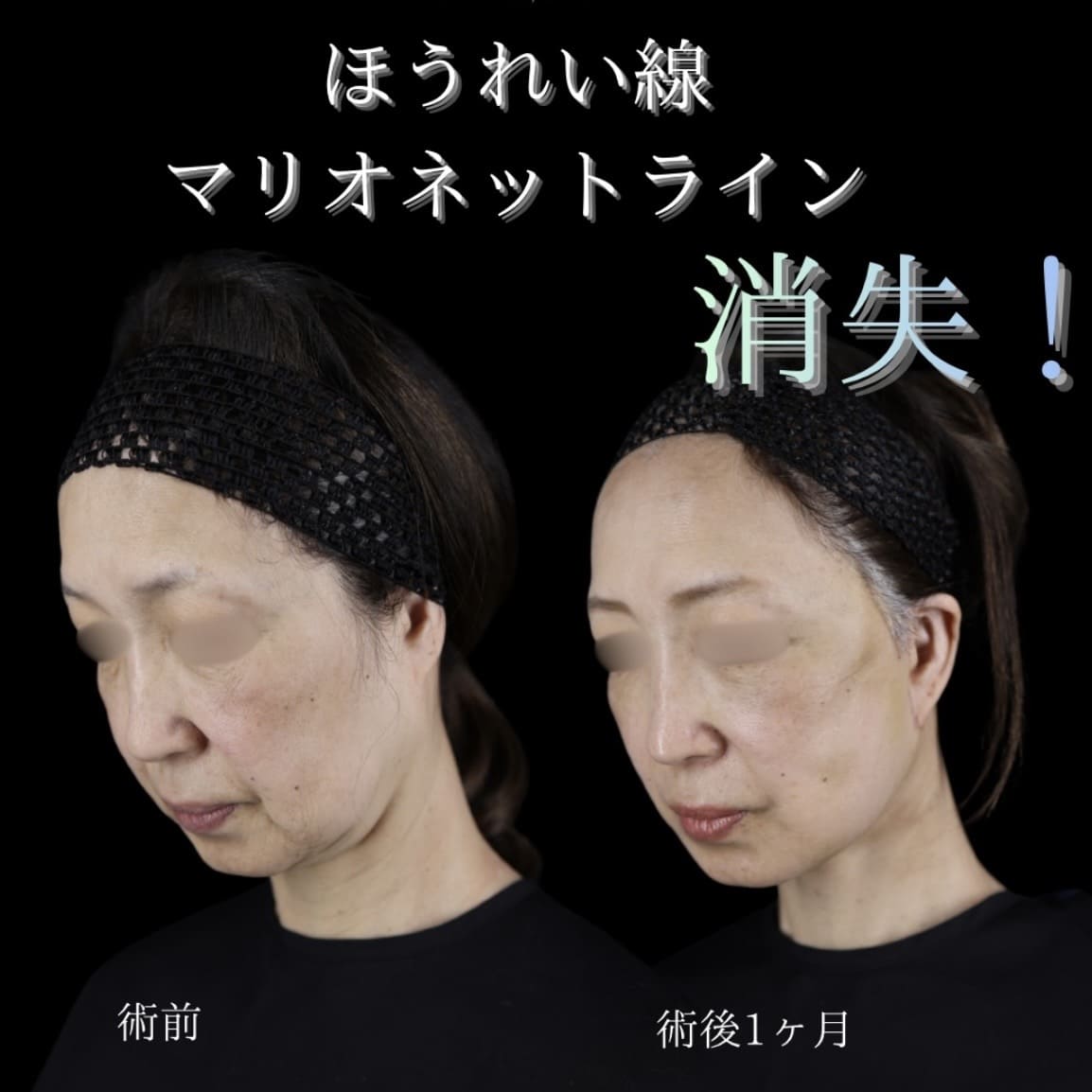 副島医師によるフェイスリフトの術前/術後1ヶ月 Дараа 