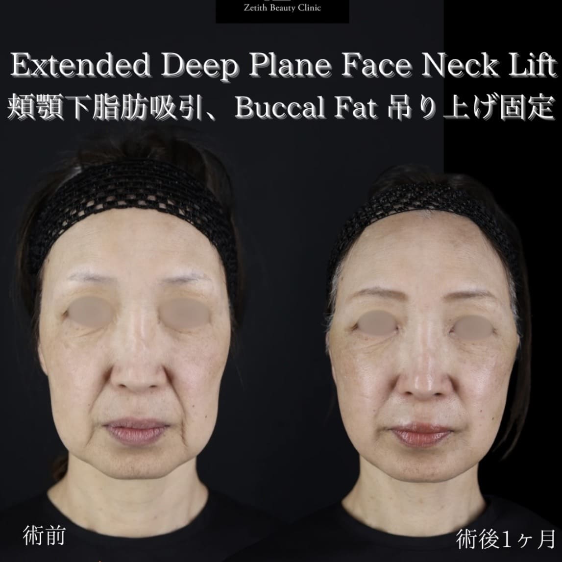 フェイスリフト
