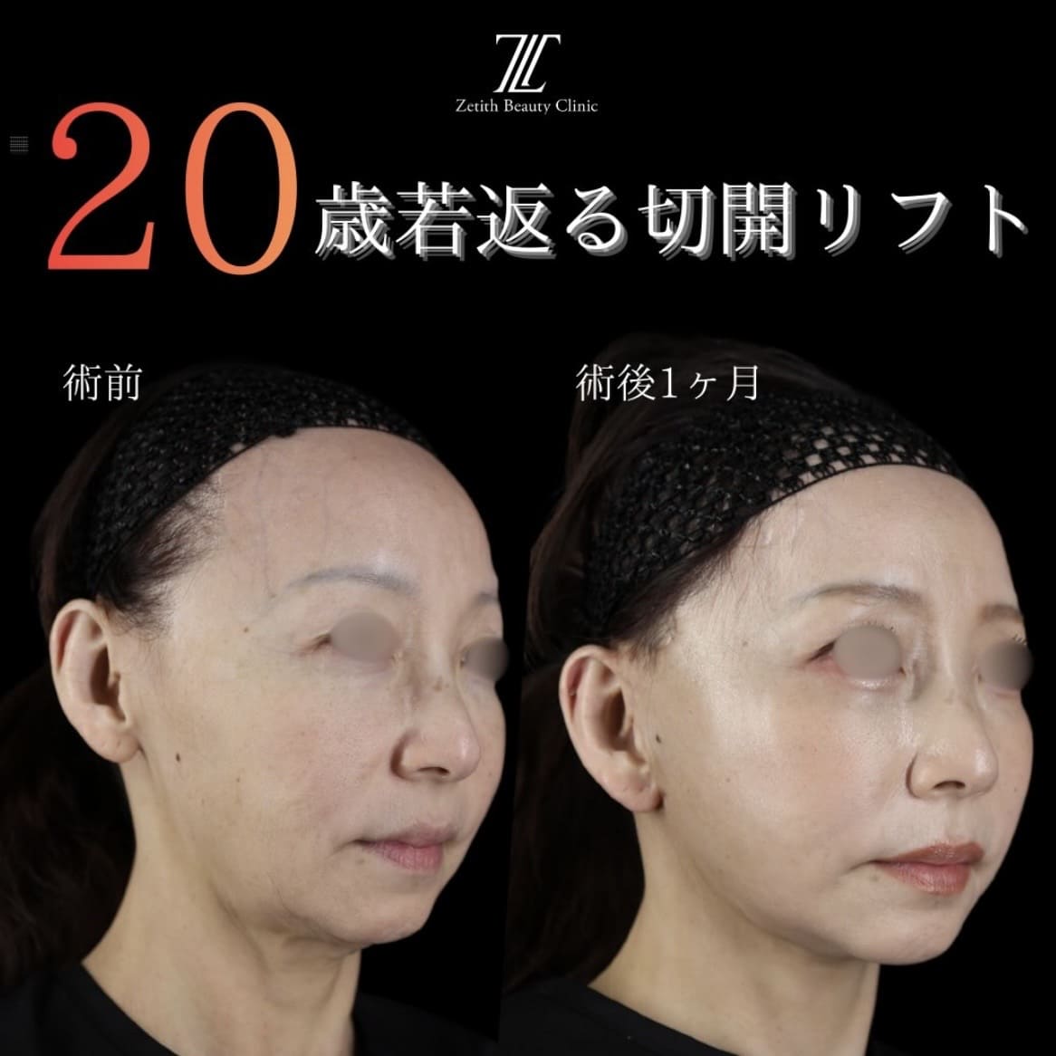 副島医師によるフェイスリフトの術前/術後1ヶ月 施術後 